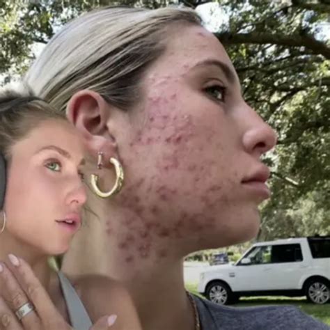 alix earle before accutane|Dermatologist Reacts to Accutane Journey from Alix Earle